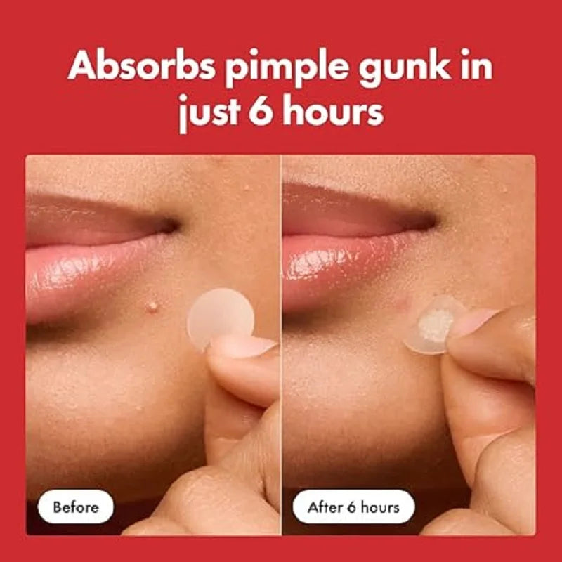 Hydrocolloid Pimple Patches for Face & Whiteheads – Night Healing Dots