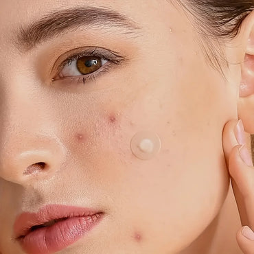 Patch for Pimples and Blemishes – Spot Stickers for Face & Skin
