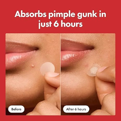 Hydrocolloid Pimple Patches for Face & Whiteheads – Night Healing Dots